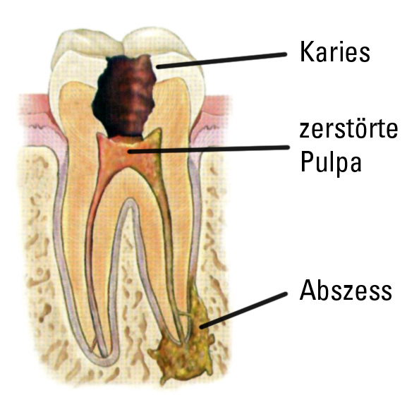 Zahn mit entzündeter Pulpa und Zahnhalteapparat