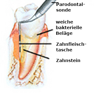 Fortgeschrittene parodontale Erkrankung mit Verlust des Zahnhalteapparates, mit Bildung einer tiefen Parodontaltasche.